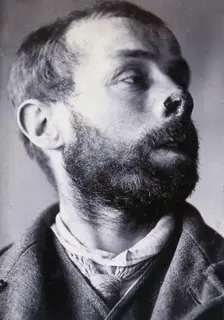 Friern Hospital, London: a man's face showing tuberculosis of the skin (lupus vulgaris), 1890/1910. Creator: Unknown