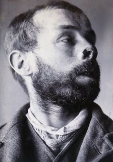 Friern Hospital, London: a man's face showing tuberculosis of the skin (lupus vulgaris), 1890/1910. Creator: Unknown