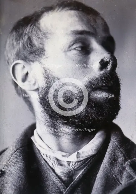 Friern Hospital, London: a man's face showing tuberculosis of the skin (lupus vulgaris), 1890/1910. Creator: Unknown.