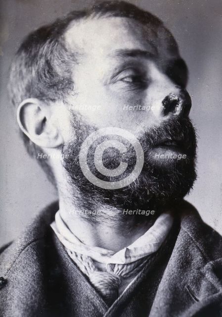 Friern Hospital, London: a man's face showing tuberculosis of the skin (lupus vulgaris), 1890/1910. Creator: Unknown.