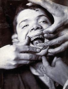 Friern Hospital, London: a boy with rotten teeth, 1890/1910. Creator: Unknown