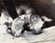 Friern Hospital, London: a child's feet viewed from below, 1890/1910. Creator: Unknown
