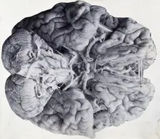 Friern Hospital, London: a diseased brain, viewed from above, 1890/1910. Creator: Unknown