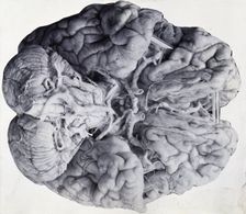 Friern Hospital, London: a diseased brain, viewed from above, 1890/1910. Creator: Unknown