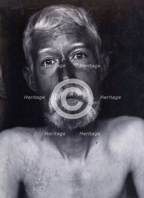 Friern Hospital, London: a patient, facing forwards, 1890/1910. Creator: Unknown.