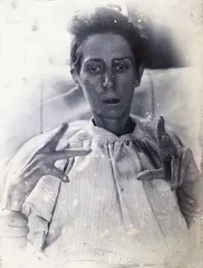 Friern Hospital, London: a woman suffering from mania, with forearm, hand and finger..., 1890/1910. Creator: Unknown