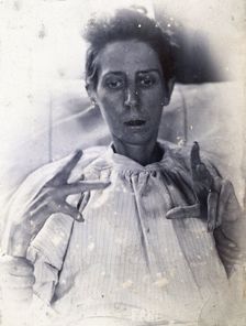 Friern Hospital, London: a woman suffering from mania, with forearm, hand and finger..., 1890/1910. Creator: Unknown