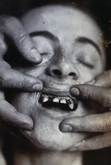 Friern Hospital, London: a young child with rotten teeth, 1890/1910. Creator: Unknown