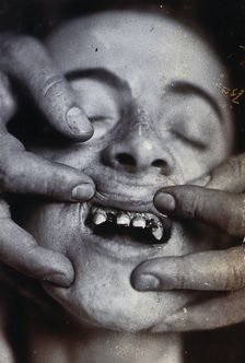 Friern Hospital, London: a young child with rotten teeth, 1890/1910. Creator: Unknown