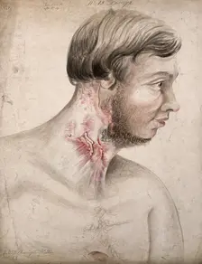 Head and chest of a man with a disease affecting his neck, seen in profile, 1856. Creator: Christopher D'Alton