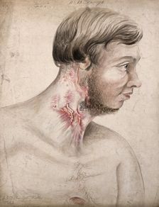 Head and chest of a man with a disease affecting his neck, seen in profile, 1856. Creator: Christopher D'Alton