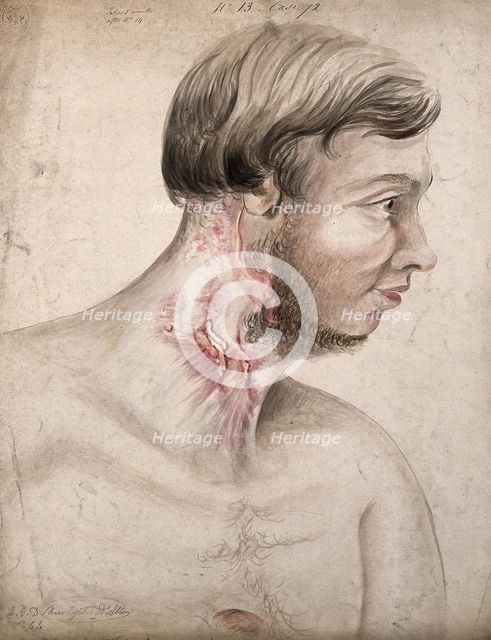 Head and chest of a man with a disease affecting his neck, seen in profile, 1856. Creator: Christopher D'Alton.