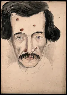 Head of a man with a disease affecting his face, 1800-1899. Creator: Christopher D'Alton