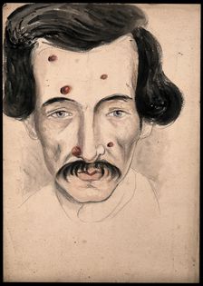 Head of a man with a disease affecting his face, 1800-1899. Creator: Christopher D'Alton
