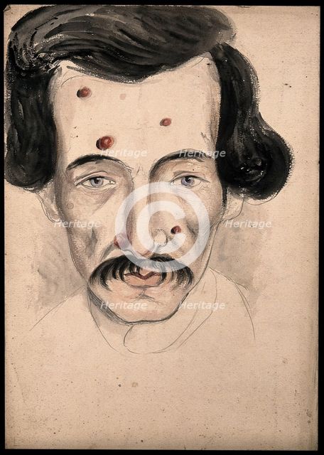 Head of a man with a disease affecting his face, 1800-1899. Creator: Christopher D'Alton.