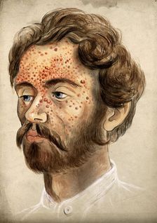 Head of a man with a severe disease affecting his face, (18)60. Creator: Christopher D'Alton
