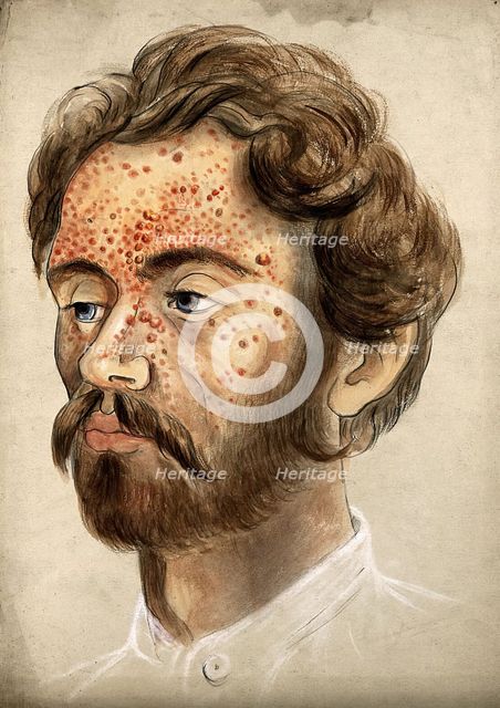 Head of a man with a severe disease affecting his face, (18)60. Creator: Christopher D'Alton.