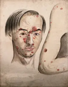 Head of a man with a severe disease affecting his face; and a section of diseased arm, 1800-1899. Creator: Christopher D'Alton