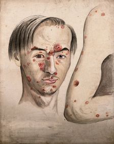 Head of a man with a severe disease affecting his face; and a section of diseased arm, 1800-1899. Creator: Christopher D'Alton