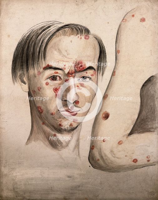 Head of a man with a severe disease affecting his face; and a section of diseased arm, 1800-1899. Creator: Christopher D'Alton.