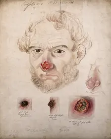 Head of a man with a severe disease affecting his nose; a detail of the nose..., 1800-1899. Creator: Christopher D'Alton