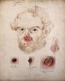 Head of a man with a severe disease affecting his nose; a detail of the nose..., 1800-1899. Creator: Christopher D'Alton
