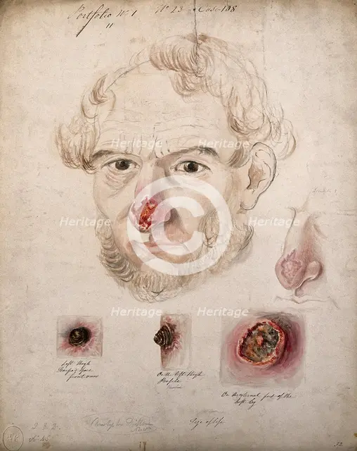 Head of a man with a severe disease affecting his nose; a detail of the nose..., 1800-1899. Creator: Christopher D'Alton.