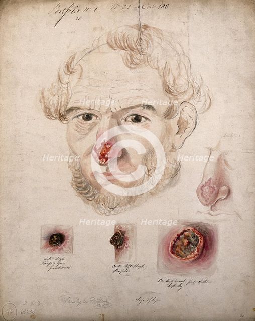 Head of a man with a severe disease affecting his nose; a detail of the nose..., 1800-1899. Creator: Christopher D'Alton.