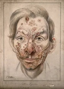 Head of a man with a syphilitic lesions affecting his face, 1874. Creator: Christopher D'Alton