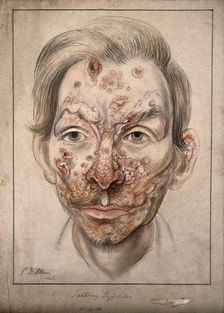 Head of a man with a syphilitic lesions affecting his face, 1874. Creator: Christopher D'Alton