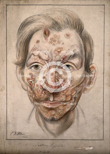 Head of a man with a syphilitic lesions affecting his face, 1874. Creator: Christopher D'Alton.