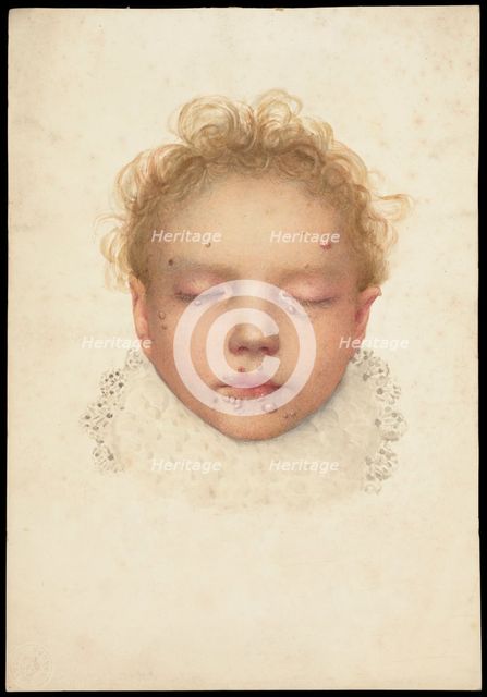 Head of a child with closed eyes and skin disease on the face, 1892. Creator: Unknown.