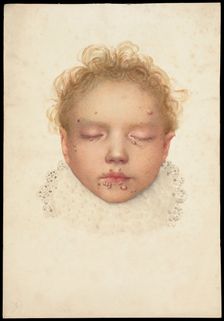 Head of a child with closed eyes and skin disease on the face, 1892. Creator: Unknown