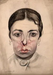 Head of a girl with a severe disease affecting her nose, 1869. Creator: Christopher D'Alton