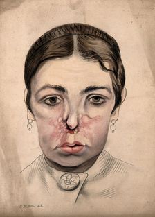 Head of a girl with a severe disease affecting her nose, 1869. Creator: Christopher D'Alton