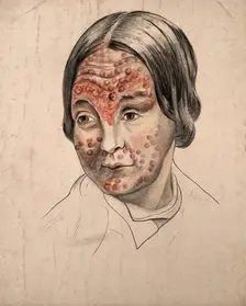 Head of a woman with a severe disease affecting her face, (18)58. Creator: Christopher D'Alton