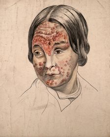 Head of a woman with a severe disease affecting her face, (18)58. Creator: Christopher D'Alton