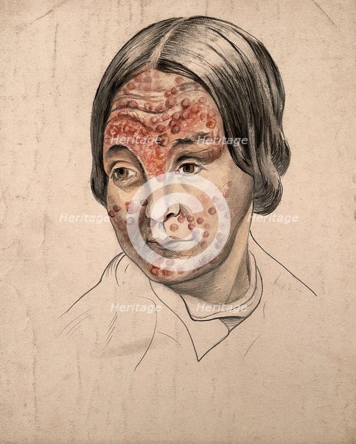 Head of a woman with a severe disease affecting her face, (18)58. Creator: Christopher D'Alton.