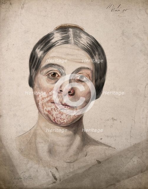 Head of a woman with a severe disease affecting her face, 1800-1899. Creator: Christopher D'Alton.