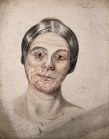 Head of a woman with a severe disease affecting her face, 1800-1899. Creator: Christopher D'Alton