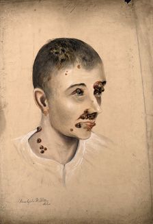 Head of a woman with a severe disease affecting her face and neck, 1864. Creator: Christopher D'Alton