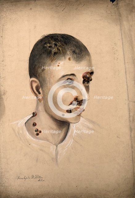 Head of a woman with a severe disease affecting her face and neck, 1864. Creator: Christopher D'Alton.