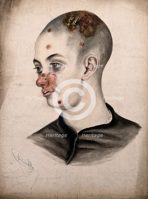 Head of a young woman with a severe disease affecting her face and scalp, (18)58. Creator: Christopher D'Alton.