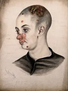 Head of a young woman with a severe disease affecting her face and scalp, (18)58. Creator: Christopher D'Alton