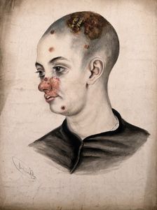 Head of a young woman with a severe disease affecting her face and scalp, (18)58. Creator: Christopher D'Alton