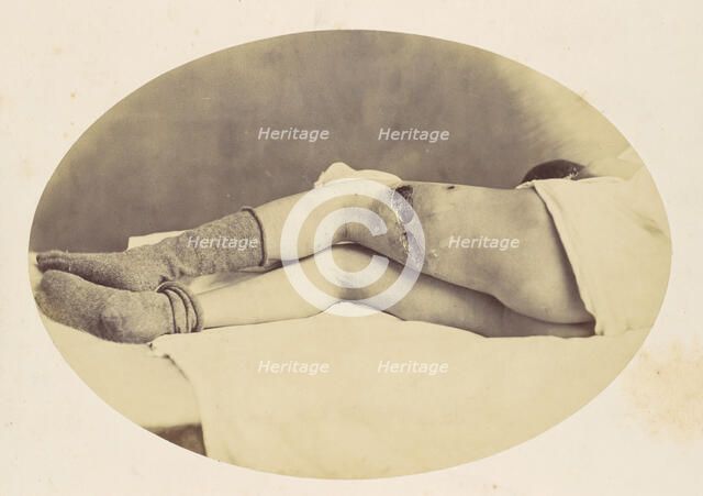 Judson C. Albright, 1865. Creator: Reed Brockway Bontecou.