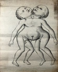 Male conjoined twins joined at the neck and chest; anterior view, 1900. Creator: Unknown