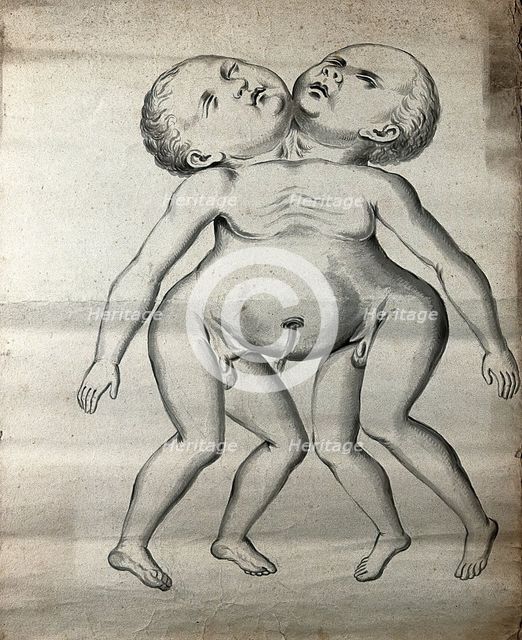 Male conjoined twins joined at the neck and chest; anterior view, 1900. Creator: Unknown.