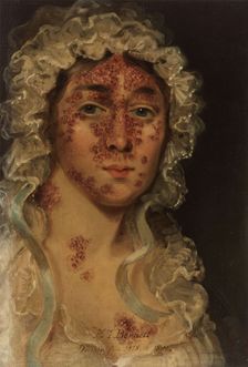 Mrs Bennett, afflicted with a skin disease, between 1818 and 1821. Creator: Unknown