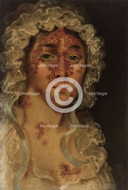 Mrs Bennett, afflicted with a skin disease, between 1818 and 1821. Creator: Unknown.